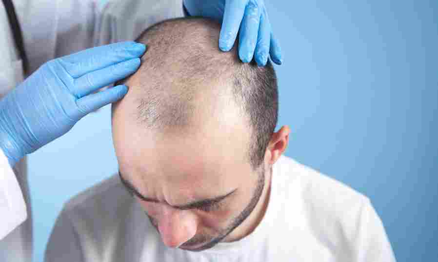 Haartransplantatie Vrouwen met Dun Haar