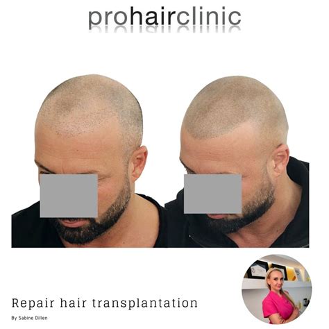 FUE Haartransplantatie: Voor En Na Foto’s