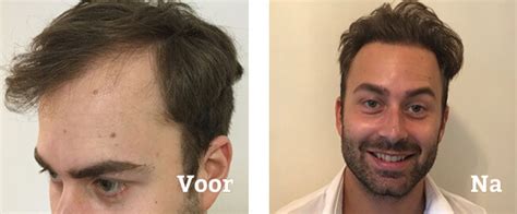 Haartransplantatie Ervaringen: Klanten Aan Het Woord