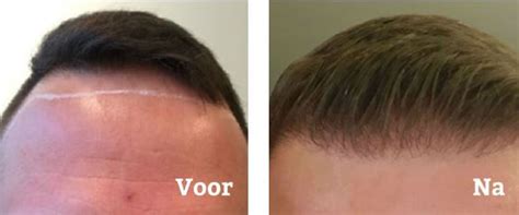 Haartransplantatie: Hoe Werkt Het?