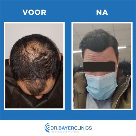 Haartransplantatie: Voor En Na Foto’s Analyse