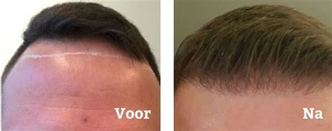 Haartransplantatie: Wanneer Is De Beste Tijd Voor Je?