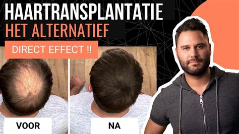 Hoe Je Haartransplantatie Kosten Kunt Besparen