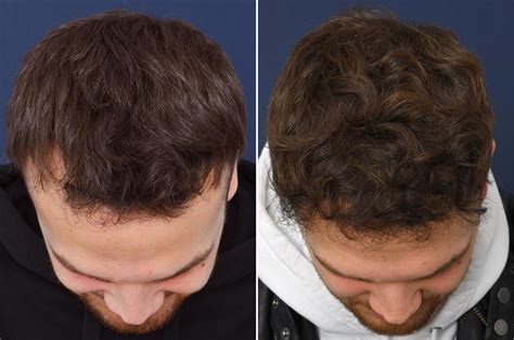 Persoonlijke Verhalen: Succes Na Haartransplantatie