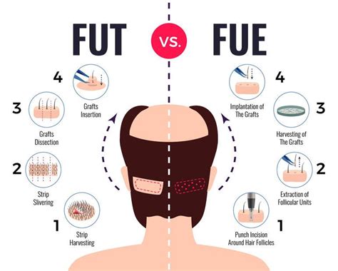 Wat Zijn De Populairste Haartransplantatie Technieken?