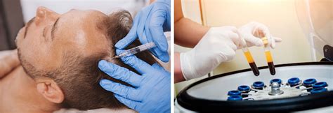 PRP Injecties En Haarverlies: Wat Is De Wetenschap Erachter?