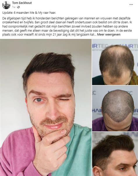 De Sleutelcomponenten Van Een Succesvolle Haartransplantatie