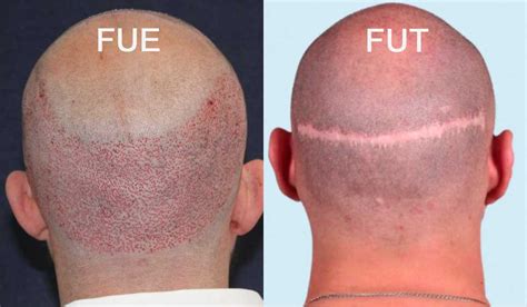 Haartransplantatie Behandelingstypes: FUE, FUT En DHI