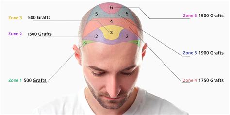 Haartransplantatie Kosten: Een Gedetailleerd Overzicht