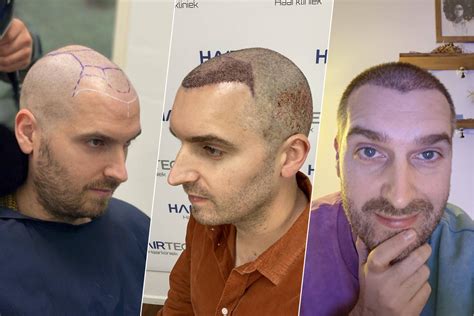 Haartransplantatie Vandaag De Dag: Trends En Ontwikkelingen