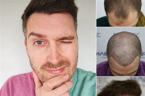 Verhalen Van Succesvolle Haartransplantaties