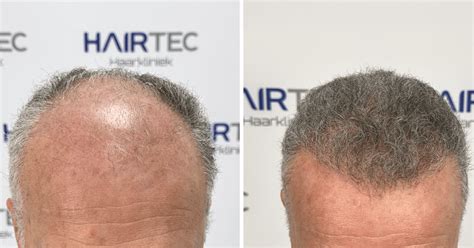Haartransplantatie En Vrijetijdsbesteding: Hoe Lang Duurt Het Herstel?