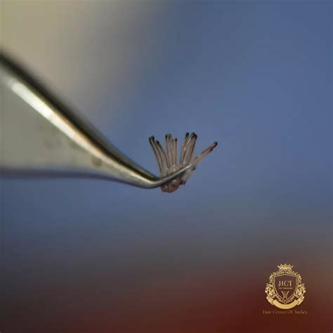 Haartransplantatie Vs. Haartransplantie: Wat Is Het Verschil?
