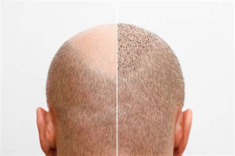 Belangrijke Tips Voor Herstel Na Een Haartransplantatie