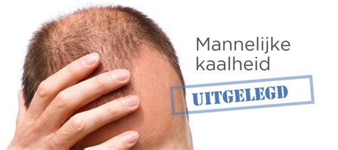 De Behandeling Van Erfelijke Kaalheid: Wat Zijn De Opties?