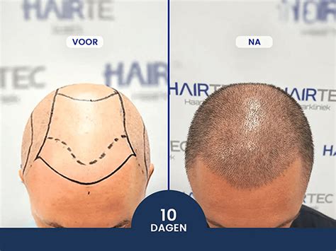 Haartransplantatie Technologieën: Een Vergelijking