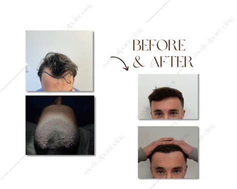 Haartransplantatie Trends In 2023: Wat Te Verwachten?
