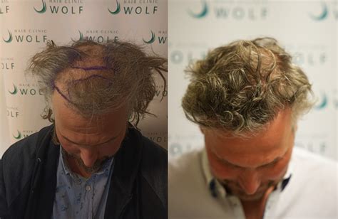 Haartransplantatie Voor Sporters: Is Het Mogelijk?